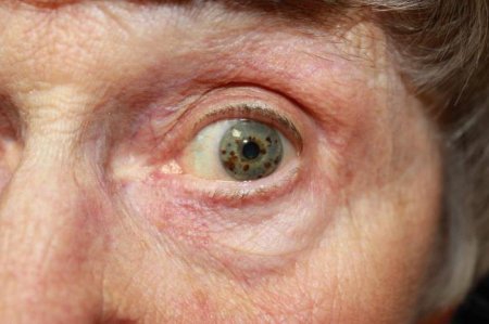 Лікування глаукоми у літніх людей: способи, відгуки
