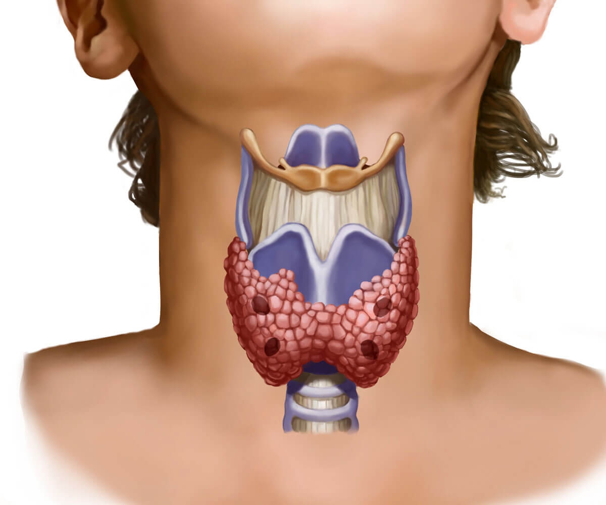 Опухоль щитовидной железы: как не пропустить опасные симптомы