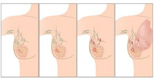 Основні причини раку молочної залози