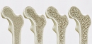 "Хрупкая эпидемия": симптомы, диагностика и лечение остеопороза