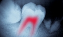 Больной зуб заражает весь организм