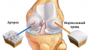 10 способів лікування артрозу колінного суглоба