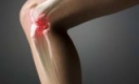 Народные методы лечения артроза коленного сустава