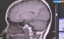 В мозге человека содержится спасение от тяжелой эпилепсии, установили неврологи