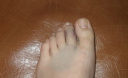 Лікування забиття при травмі пальця ноги. Видалення гематоми