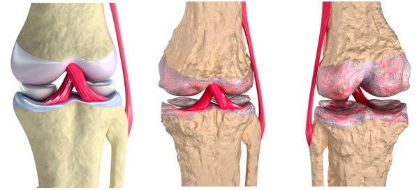 Як розвиваються хвороби суглобів Як розвиваються хвороби суглобів