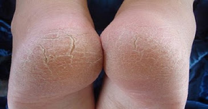 7 способов сделать пятки, как у младенца. Забудь про сухость и трещины!