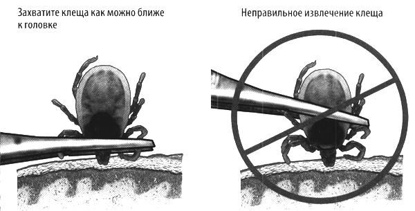 Как вытащить клеща Как вытащить клеща