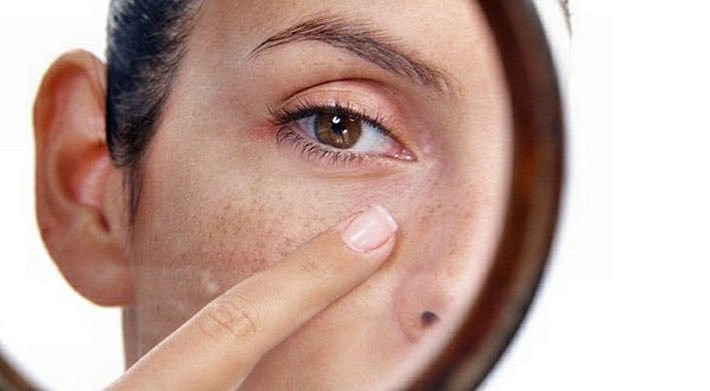 7 натуральних засобів для видалення пігментних плям на обличчі