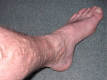 Лікування болі в ногах народними засобами