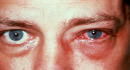 Болит правый или левый глаз – в чем опасность?