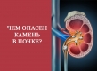 Чем опасен камень в почке?