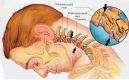 Как убрать соли при шейном остеохондрозе. Комплекс упражнений