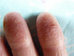 Причини глибоких тріщин на пальцях рук, і методи їх лікування