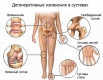 Больные суставы: весенняя очистка Больные суставы: весенняя очистка