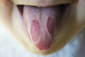 "Коронавірусний язик". Вчені припускають, що виявили новий симптом COVID-19 