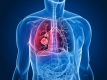 Вчені: Побороти рак легенів можна за 30 хвилин за допомогою гарячої голки