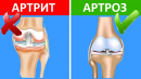 Артрит і артроз: симптоми, причини та відмінності Артрит і артроз: симптоми, причини та відмінності