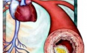 High Cholesterol Signs and Symptoms