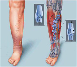 Чи можна повністю вилікувати варикоз